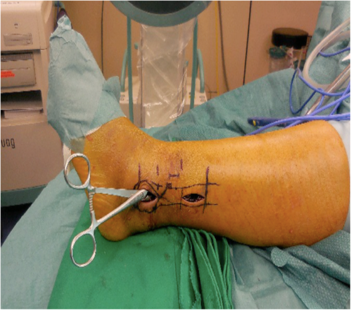 MIPO Surgery